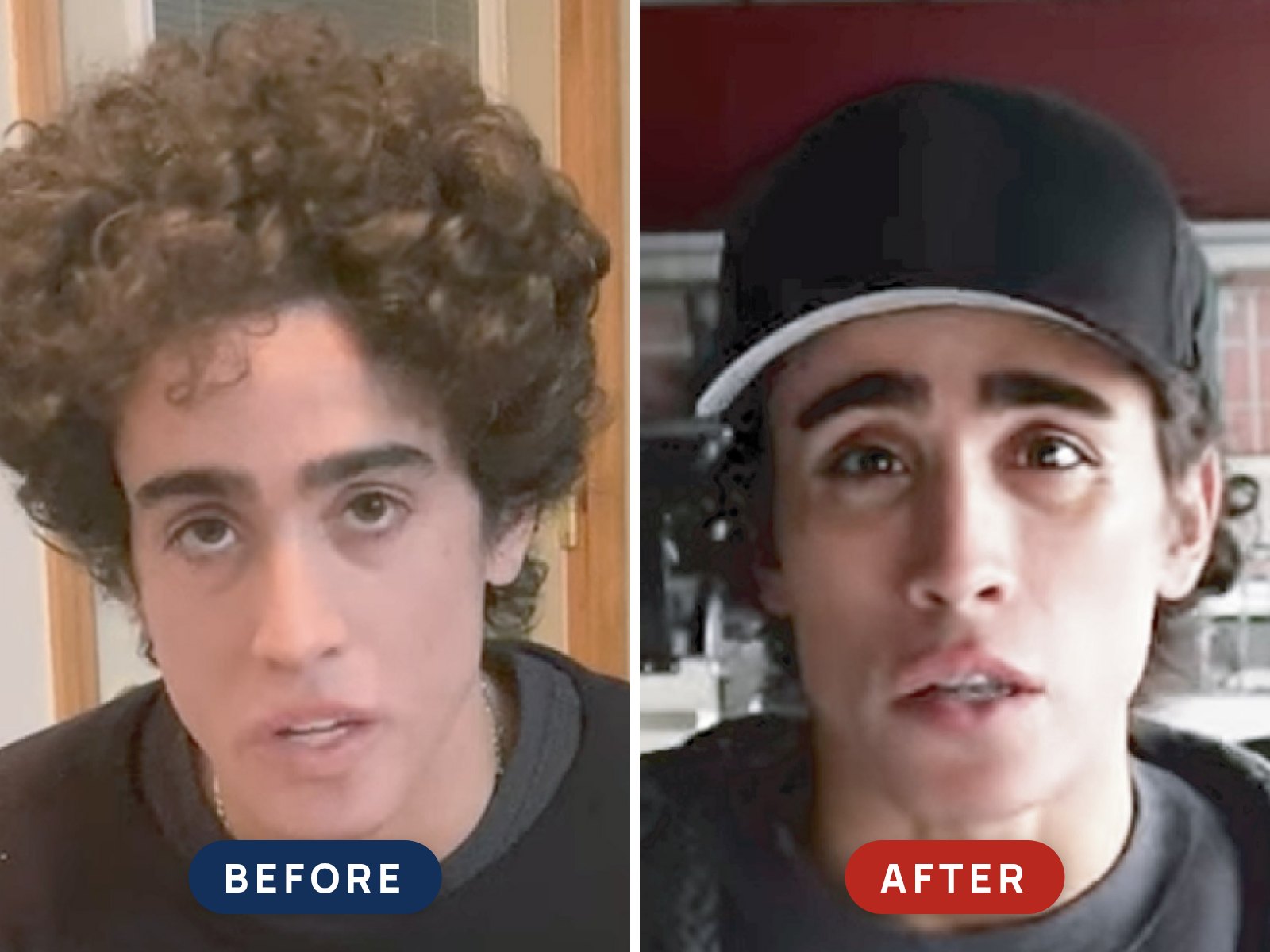 Before and after photos of Frank Tufano's surgery with Dr. Taban